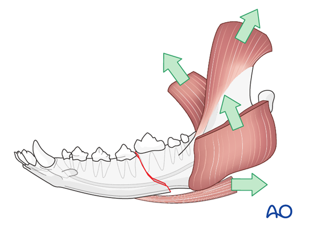 general considerations with mandible fractures