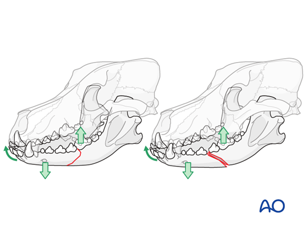 general considerations with mandible fractures