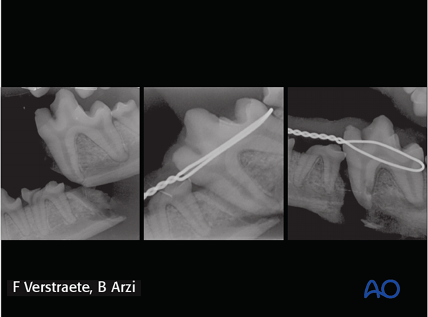 complications with mandible fractures