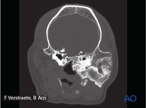 complications with mandible fractures