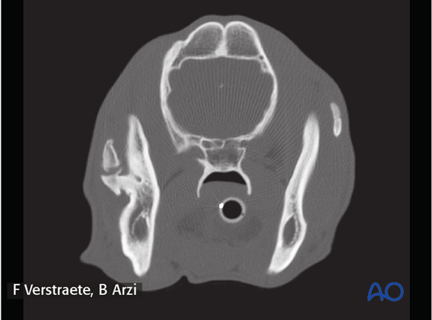 complications with mandible fractures