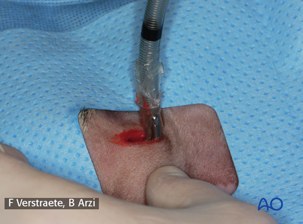 pharyngostomy intubation