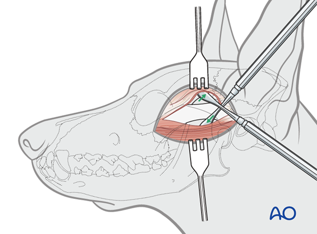 lateral approach to the zygomatic arch