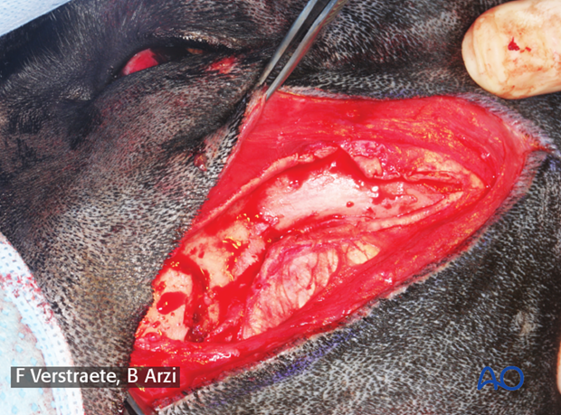 lateral approach to the zygomatic arch