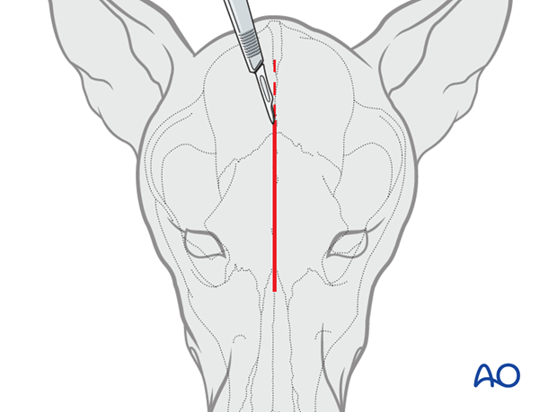 dorsal midline approach