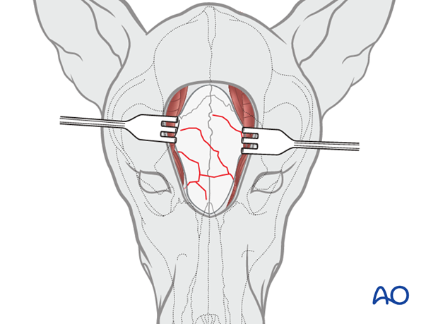 dorsal midline approach