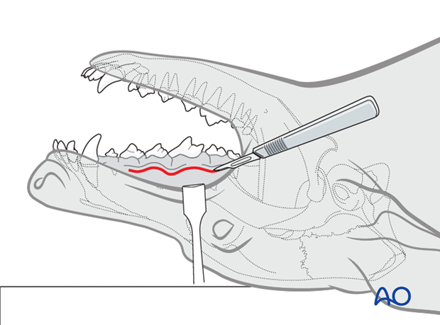 intraoral approach to the maxilla