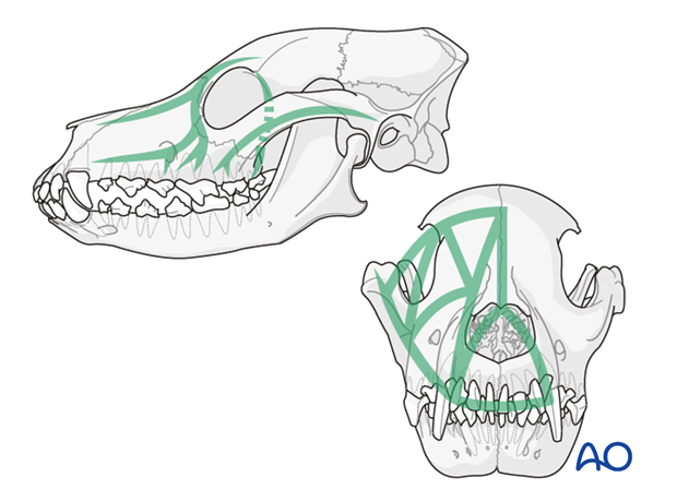 general considerations with midface fractures