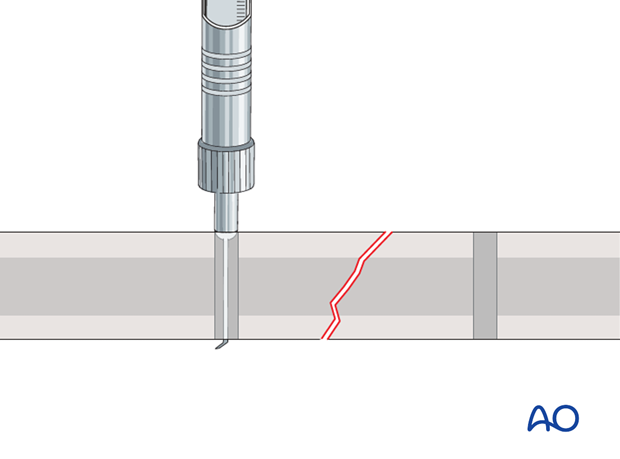 plate fixation