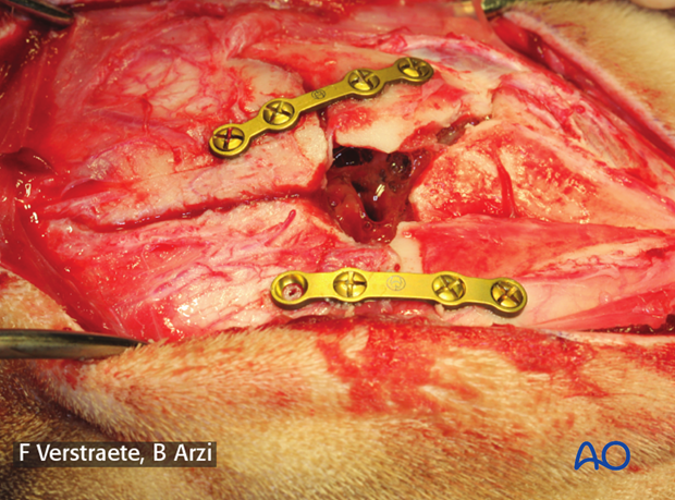 general considerations with midface fractures