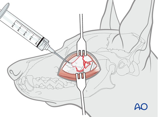 plate fixation