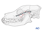 midface zygomatic arch comminuted