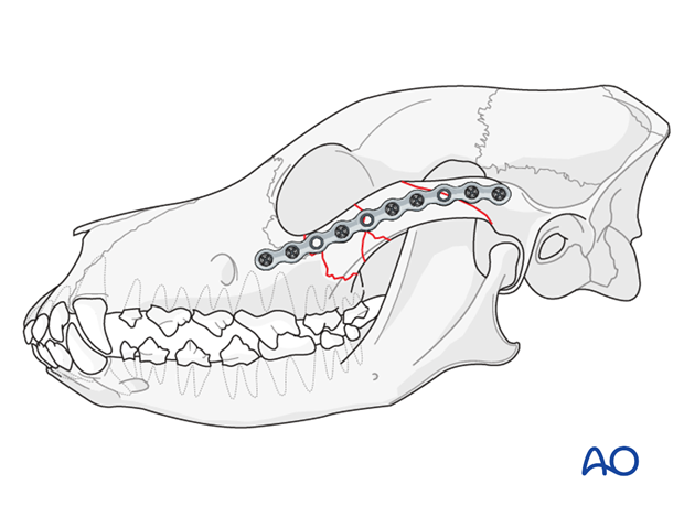 midface zygomatic arch comminuted