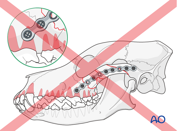 plate fixation