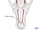 midface palatal nondisplaced