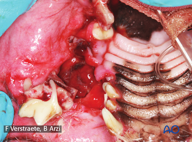 midface frontonasal simple