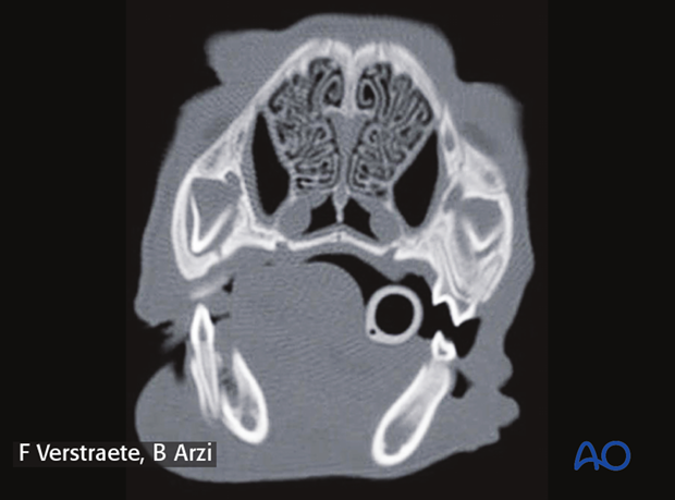 management of fractures in the pediatric patient