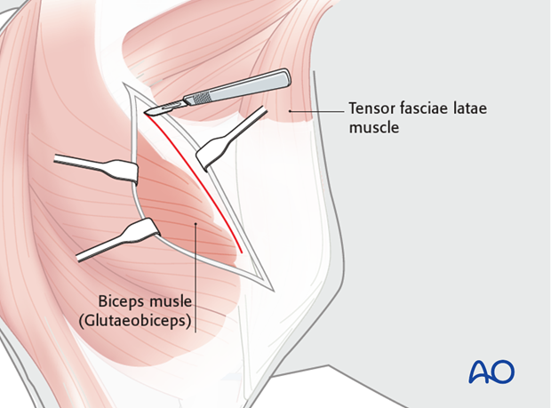 lateral approach to the femur