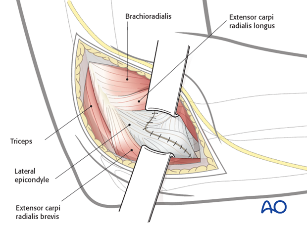 lateral approach