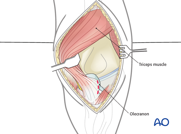 posterior approach without olecranon osteotomy