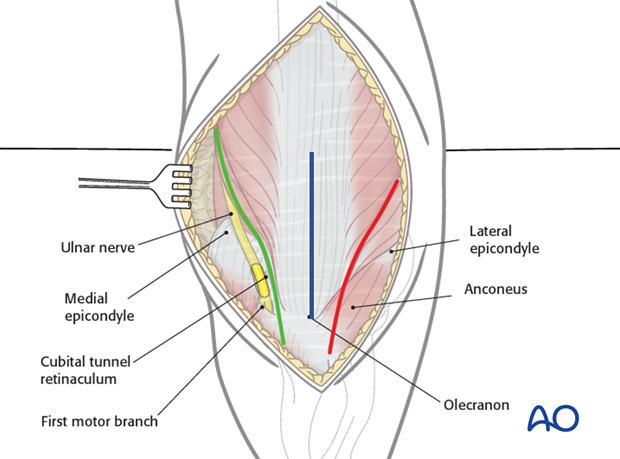 posterior approach without olecranon osteotomy