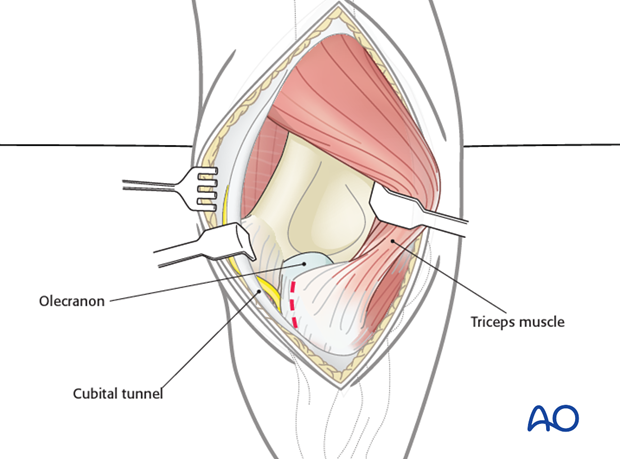 posterior approach without olecranon osteotomy