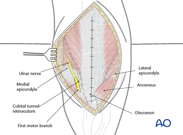 posterior approach without olecranon osteotomy