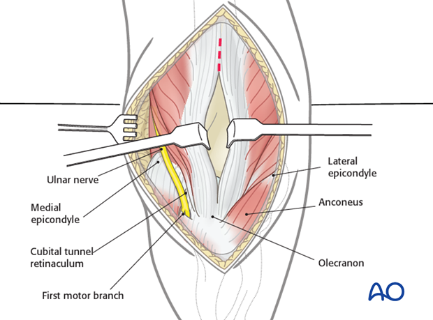 posterior approach without olecranon osteotomy