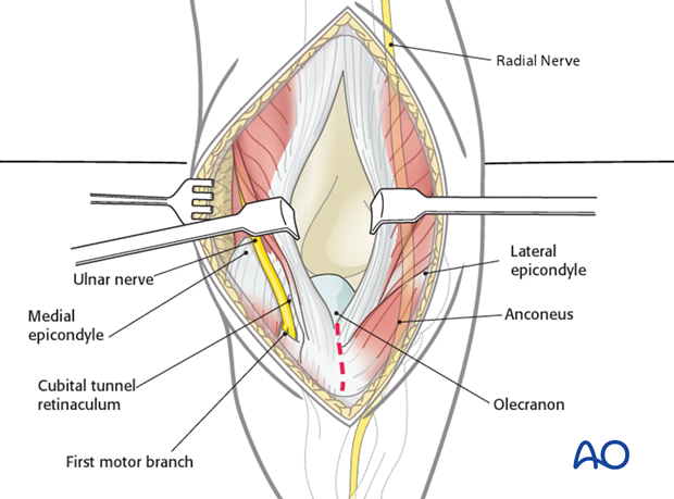 posterior approach without olecranon osteotomy