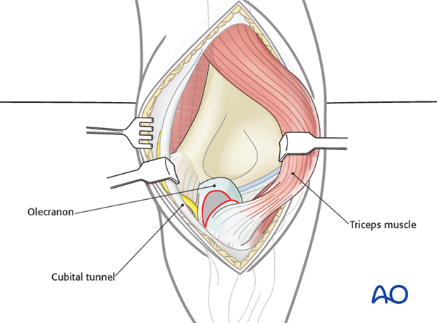 posterior approach without olecranon osteotomy