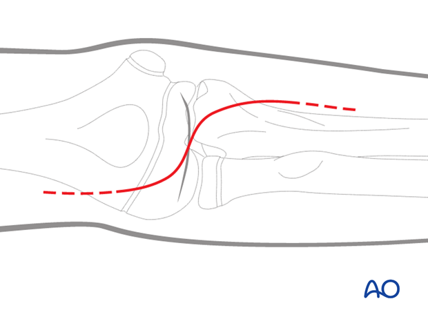 anterior approach