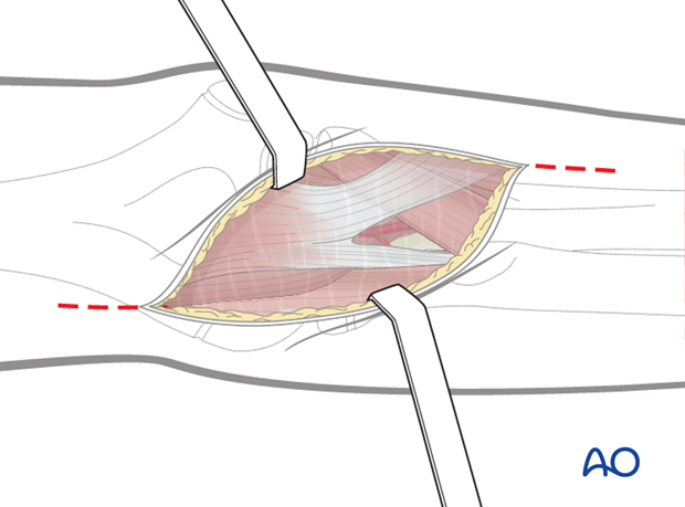 anterior approach