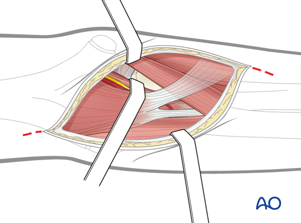 anterior approach