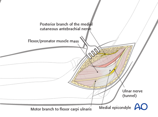 medial approach