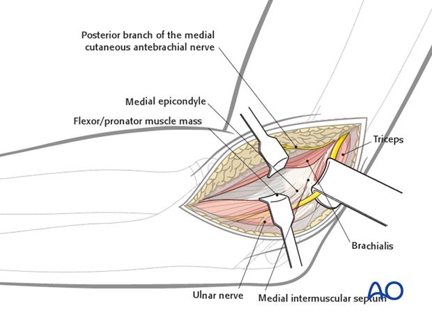 medial approach