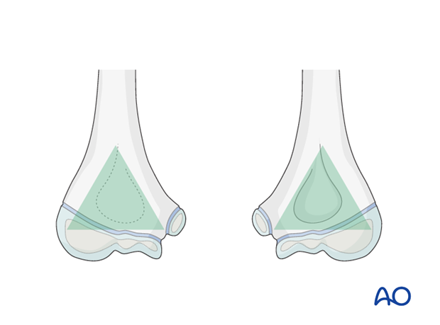 distal humeral surgical and developmental anatomy