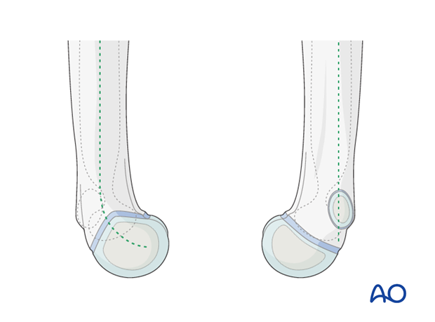 distal humeral surgical and developmental anatomy