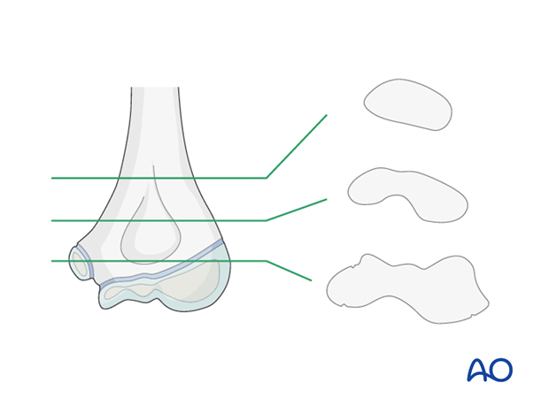 distal humeral surgical and developmental anatomy