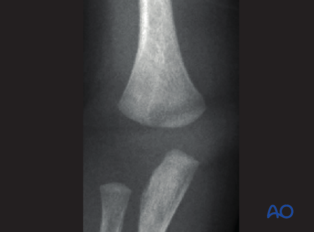 distal humeral surgical and developmental anatomy