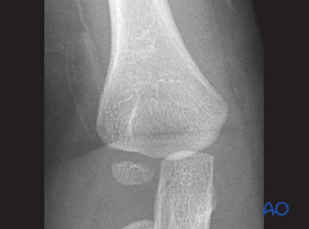 distal humeral surgical and developmental anatomy