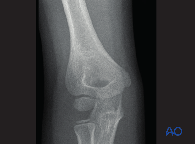 distal humeral surgical and developmental anatomy