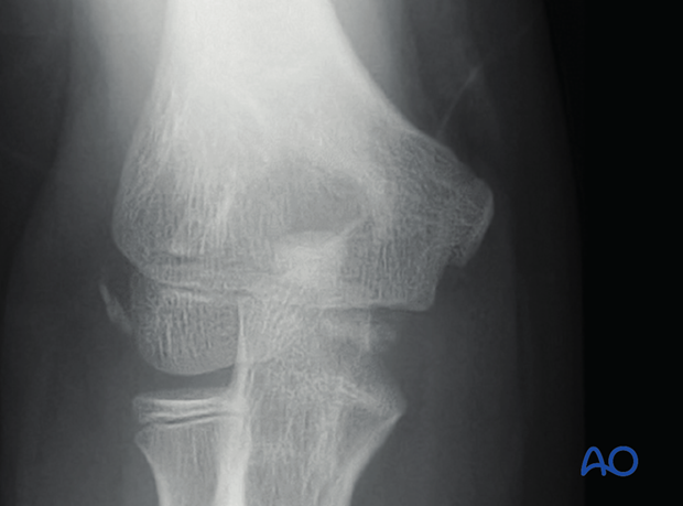 distal humeral surgical and developmental anatomy