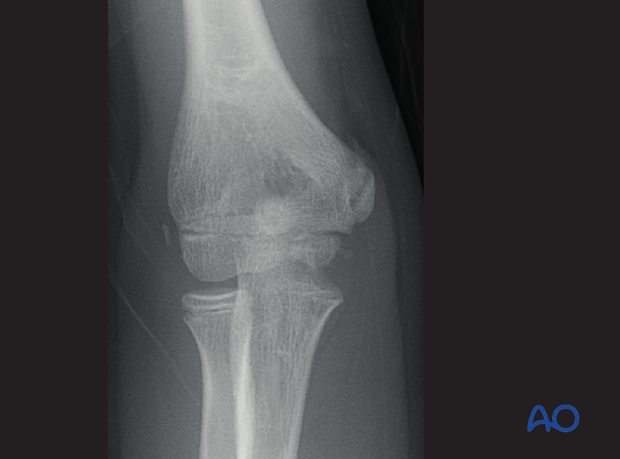 distal humeral surgical and developmental anatomy