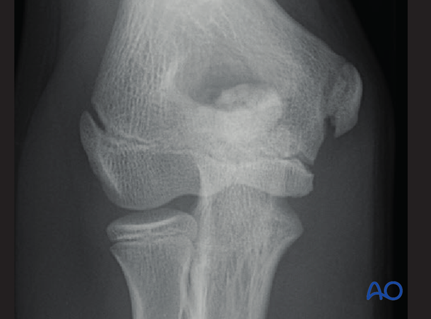 distal humeral surgical and developmental anatomy