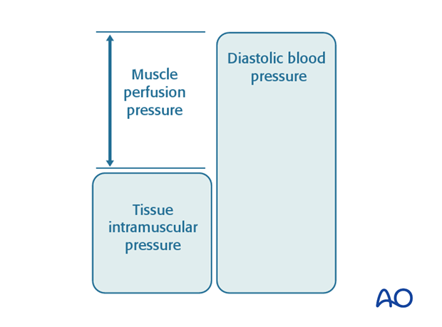 compartment syndrome