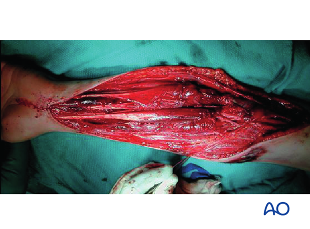 compartment syndrome