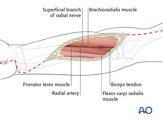 compartment syndrome