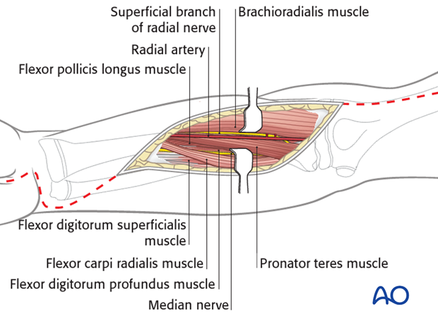 compartment syndrome