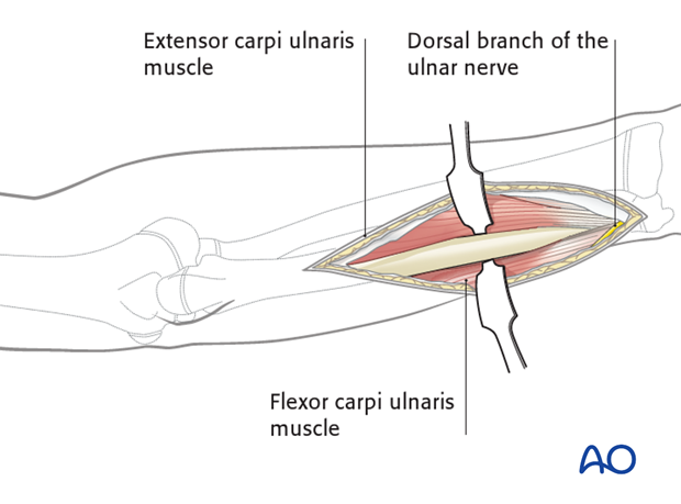 compartment syndrome