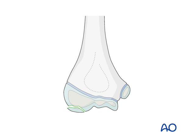 timing of treatment of fractures of the distal humerus